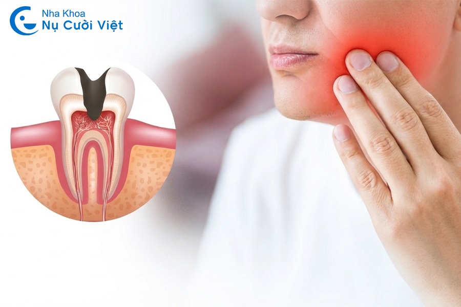 Nụ Cười Việt - 3 giai đoạn viêm tủy răng bạn cần nắm để điều trị kịp thời