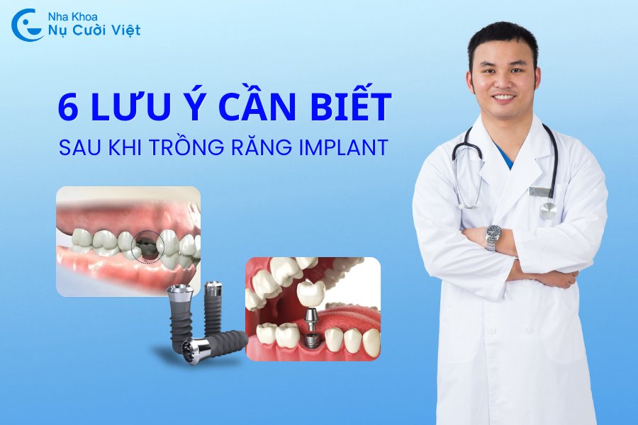 Nụ Cười Việt - 6 LƯU Ý CHĂM SÓC SAU KHI TRỒNG RĂNG IMPLANT AN TOÀN, HIỆU QUẢ, TRÁNH BIẾN CHỨNG