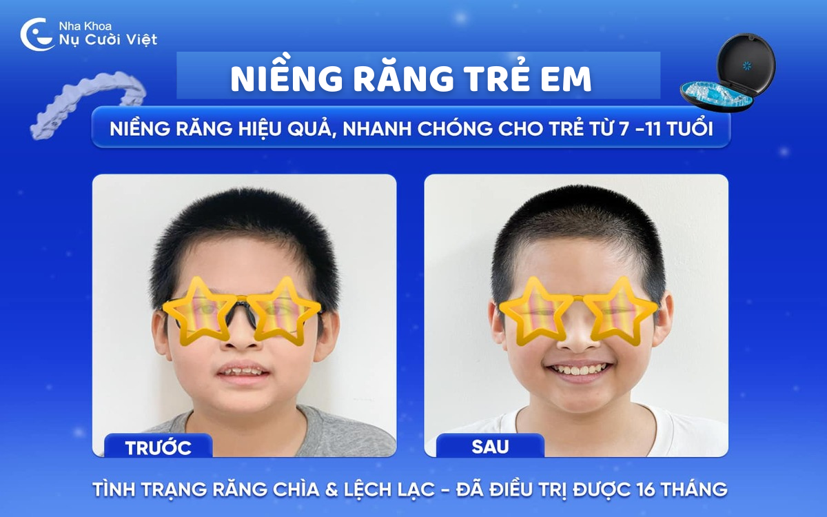niềng răng trẻ em là gì