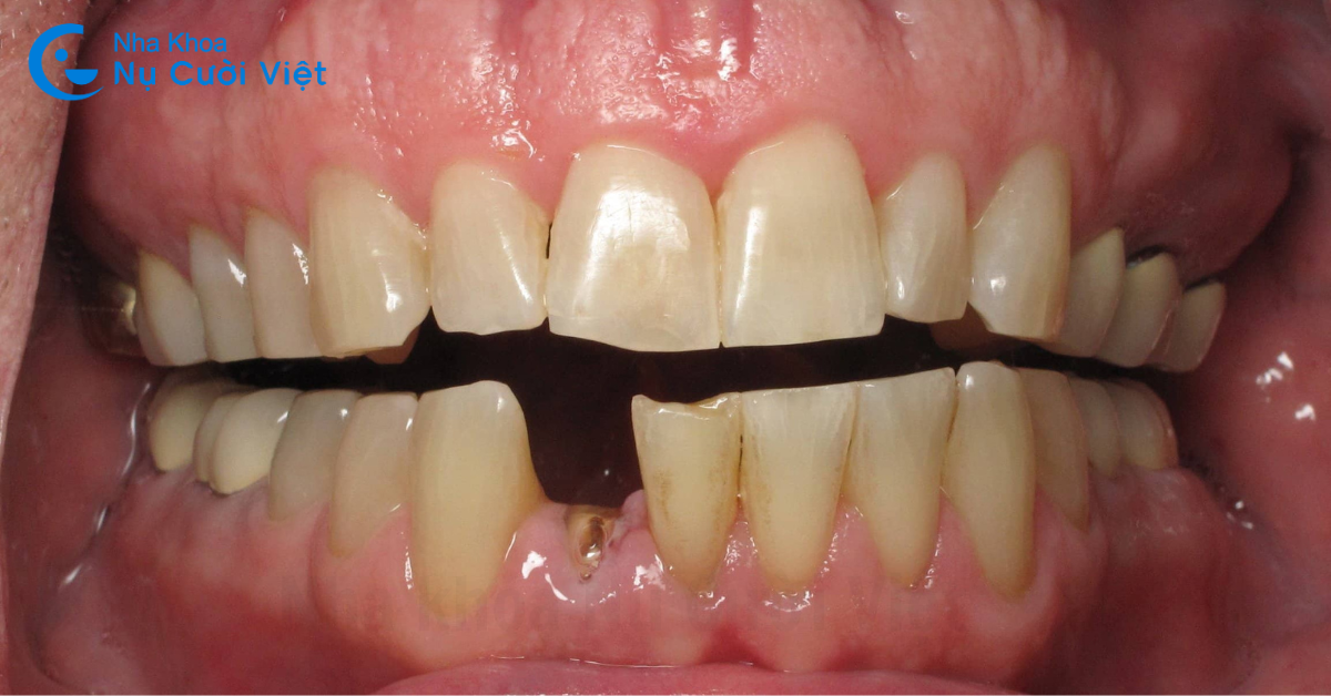ảnh hưởng của mất 1 răng cửa