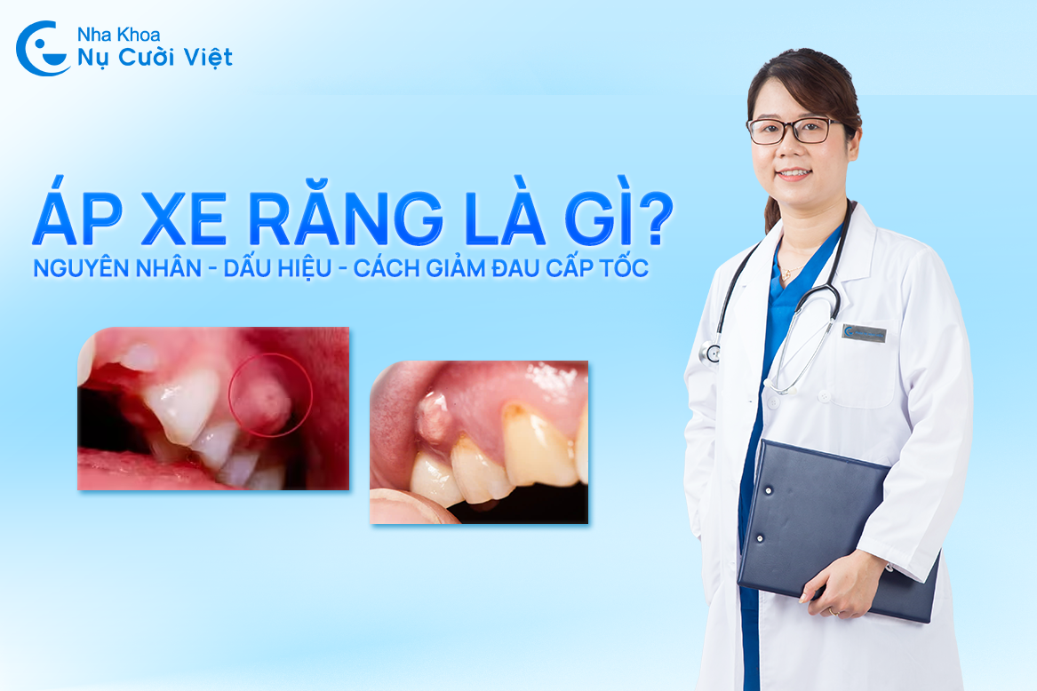 Nụ Cười Việt - Áp xe răng: 5 nguyên nhân & Cách giảm đau cấp tốc và dấu hiệu cần đi khám nha khoa