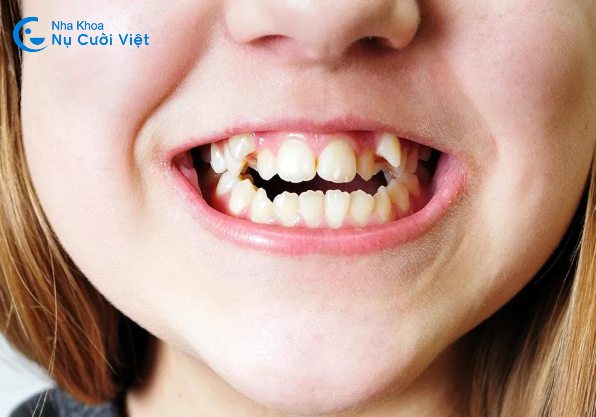 Nụ Cười Việt - Bật mí cách chữa răng mọc không đều cực hiệu quả