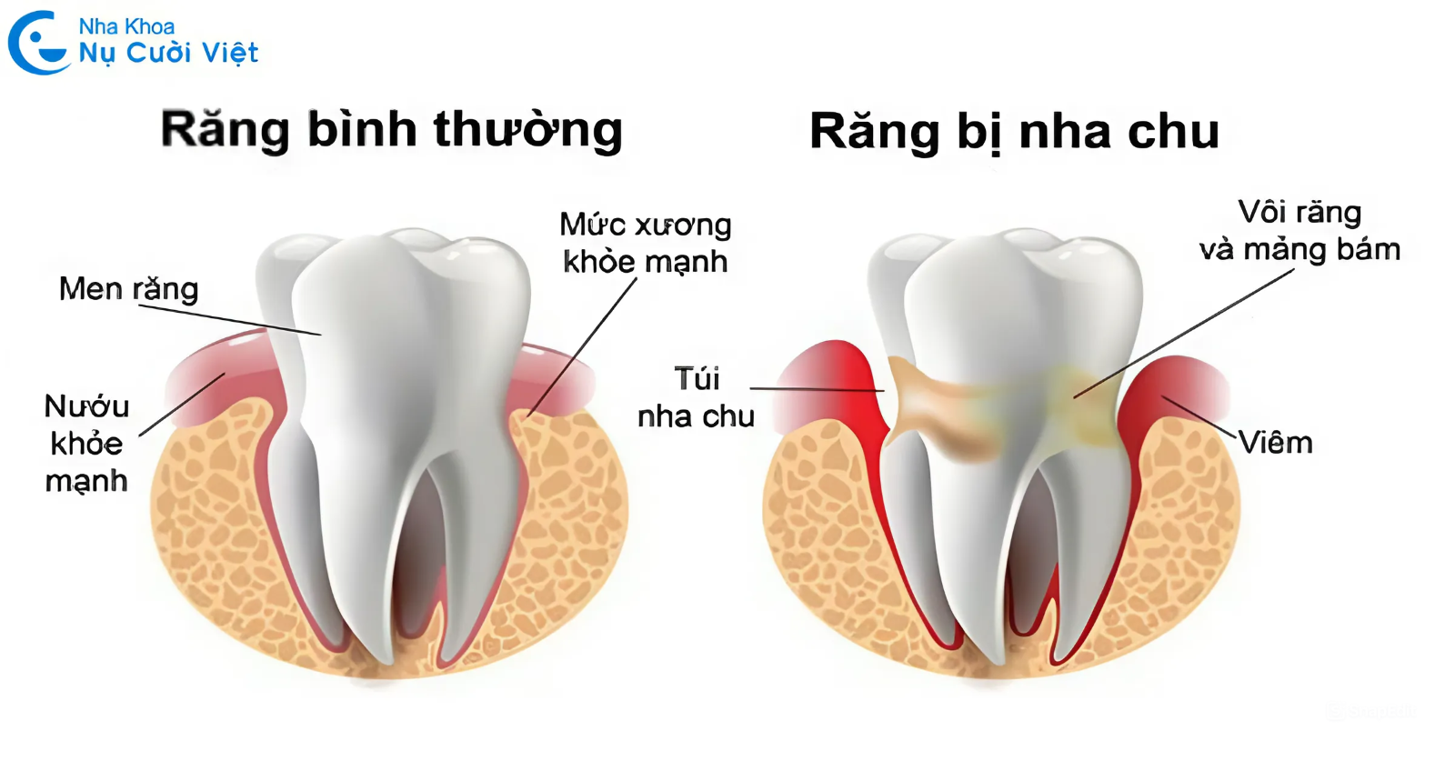 bệnh viêm nha chu là gì