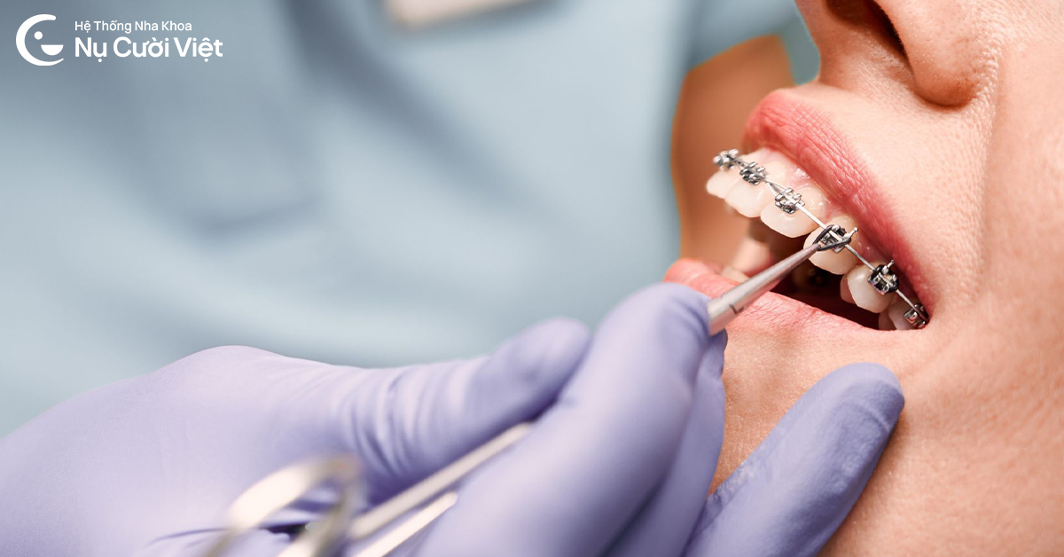 biểu hiện khi mới niềng răng