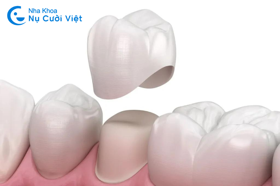 Nụ Cười Việt - Bọc răng sứ sử dụng được bao lâu?