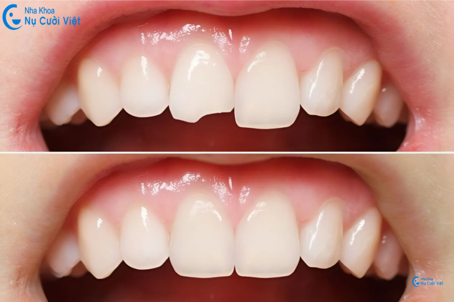 Nụ Cười Việt - BỌC SỨ 2 RĂNG CỬA GIÁ BAO NHIÊU? NÊN CHỌN LOẠI NÀO LÀ TỐT NHẤT?