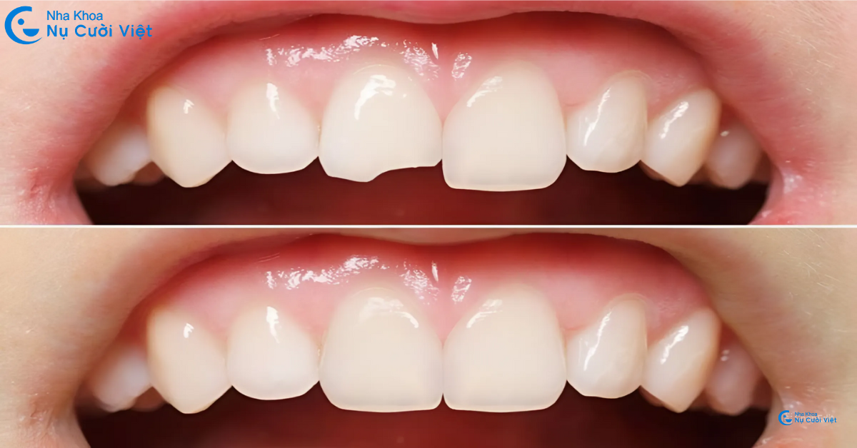bọc sứ 2 răng cửa là gì