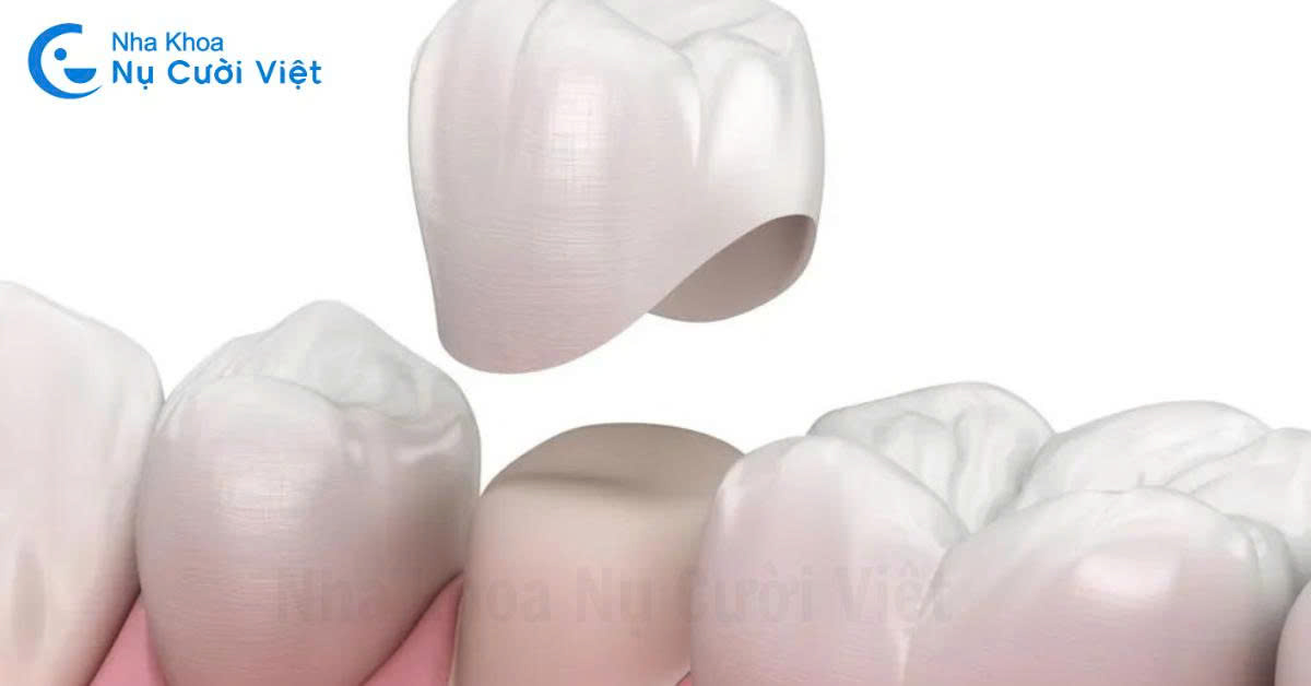 bọc sứ điều trị sâu kẽ răng