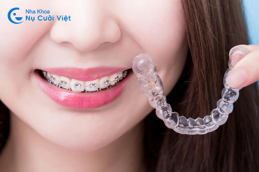 Nụ Cười Việt - Các loại niềng răng được nhiều người lựa chọn nhất hiện nay
