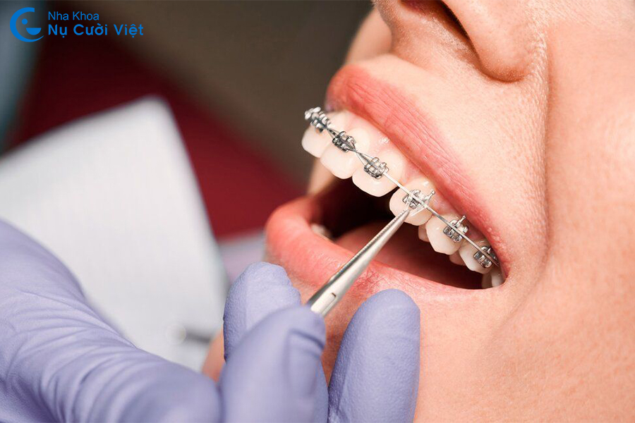 Nụ Cười Việt - Giải đáp A-Z về các loại thun niềng răng & Công dụng, cách sử dụng