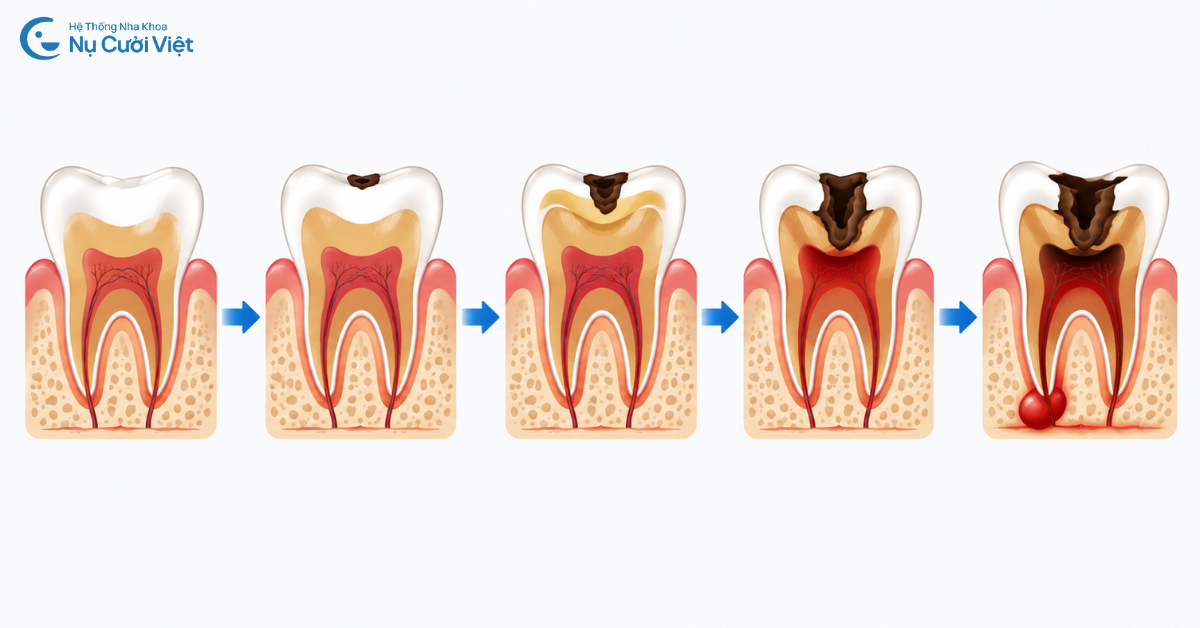 các mức độ sâu răng