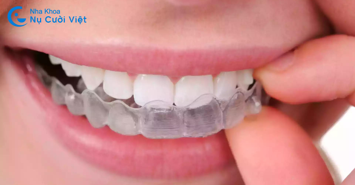 cách giảm đau khi niềng răng invisalign