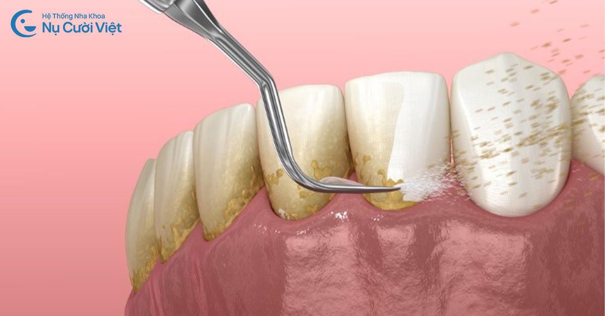 cách phòng ngừa viêm nướu khi niềng răng
