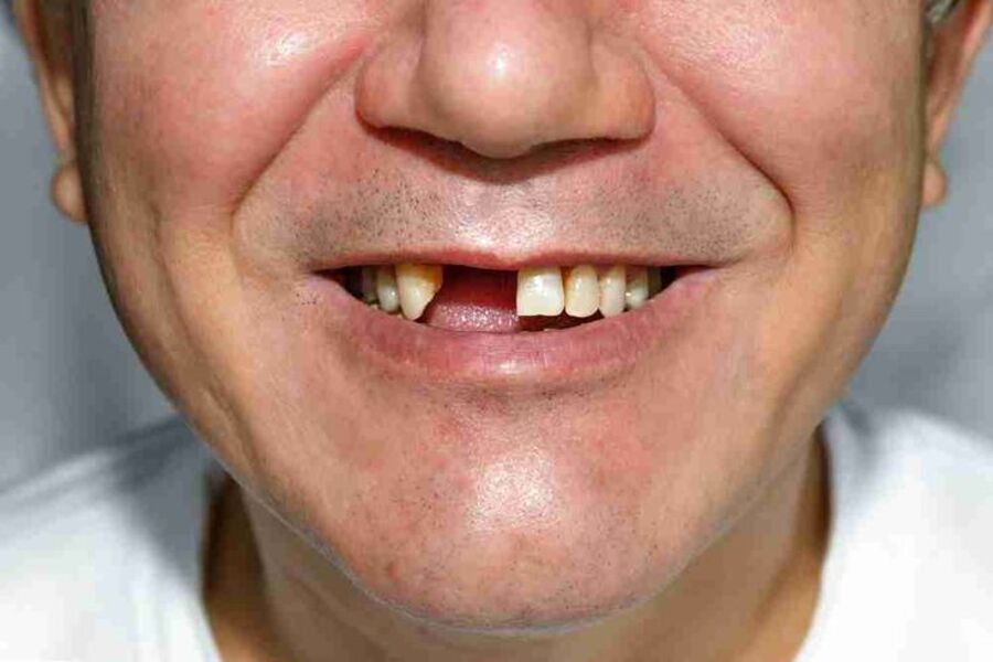 Nụ Cười Việt - CÁCH XỬ LÝ KHI MẤT 1 RĂNG CỬA: TRỒNG RĂNG IMPLANT HAY CẦU RĂNG SỨ? 