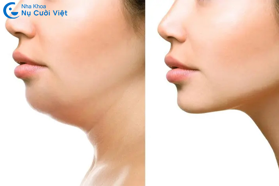 Nụ Cười Việt - Cằm lẹm là gì? Dấu hiệu nhận biết và phương pháp khắc phục hiệu quả
