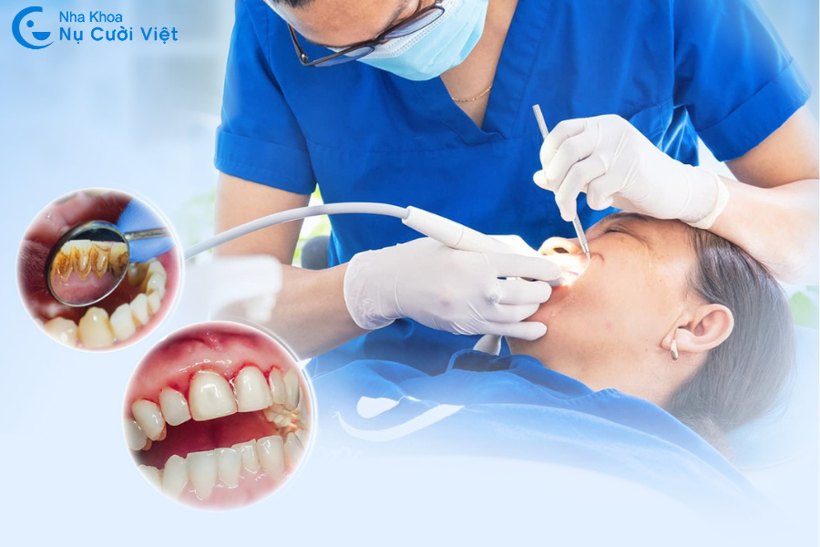 Nụ Cười Việt - Tư vấn bác sĩ: Cạo vôi răng có làm răng yếu đi không?