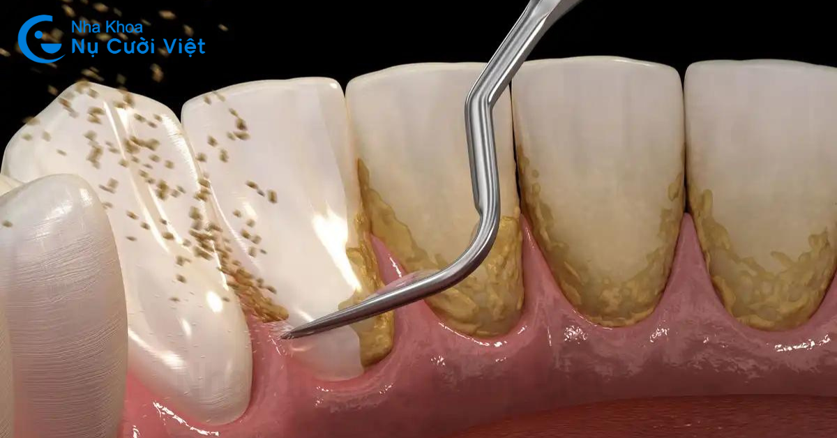 khắc phục tình trạng tụt lợi khi niềng răng