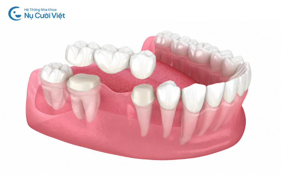 Nụ Cười Việt - Làm cầu răng sứ có đau không, độ bền như thế nào?