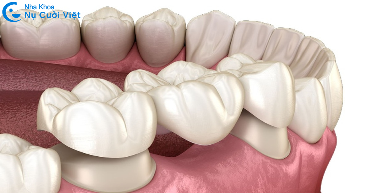 làm cầu răng sứ cho răng số 6