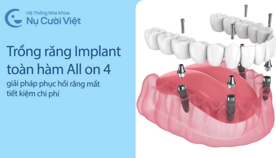 Nụ Cười Việt - Trồng răng toàn hàm All-on-4: Giải pháp phục hồi tiết kiệm chi phí cho người mất răng toàn hàm