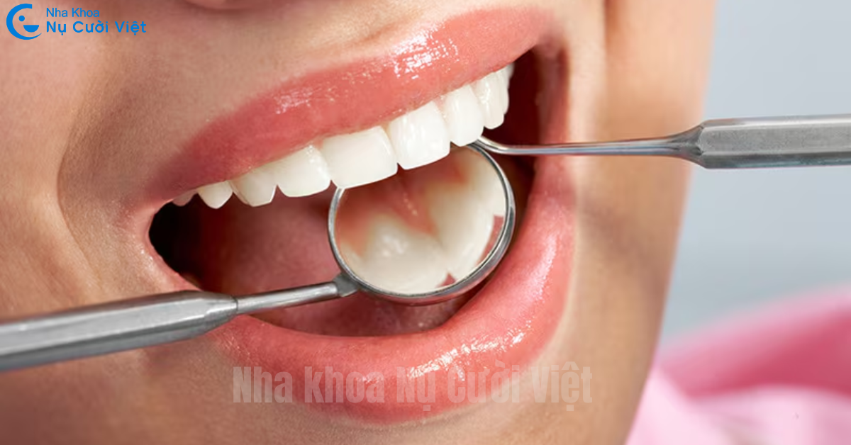 chăm sóc sau khi trám răng cửa sâu