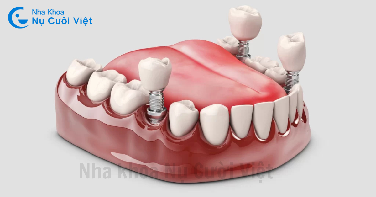 chăm sóc răng sau khi gắn răng sứ lên trụ implant