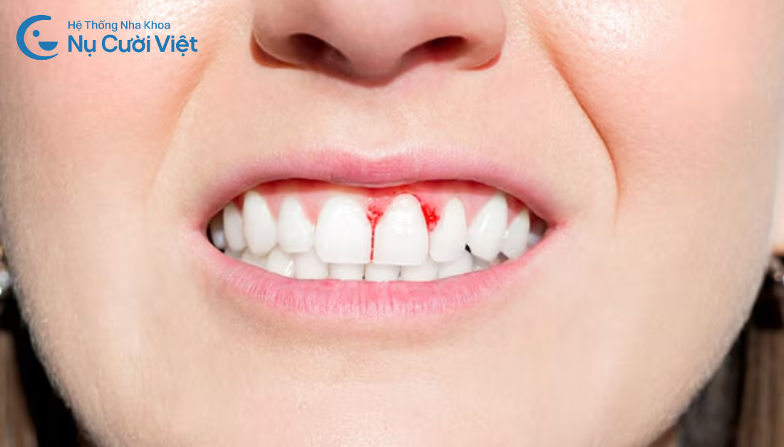 chảy máu chân răng do sưng nướu