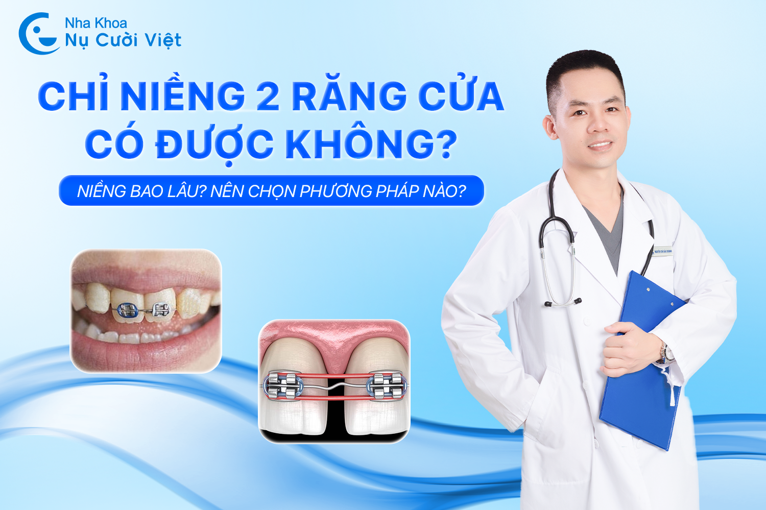 Nụ Cười Việt - CHỈ NIỀNG 2 RĂNG CỬA CÓ ĐƯỢC KHÔNG? NIỀNG BAO LÂU? NÊN CHỌN PHƯƠNG PHÁP NÀO?