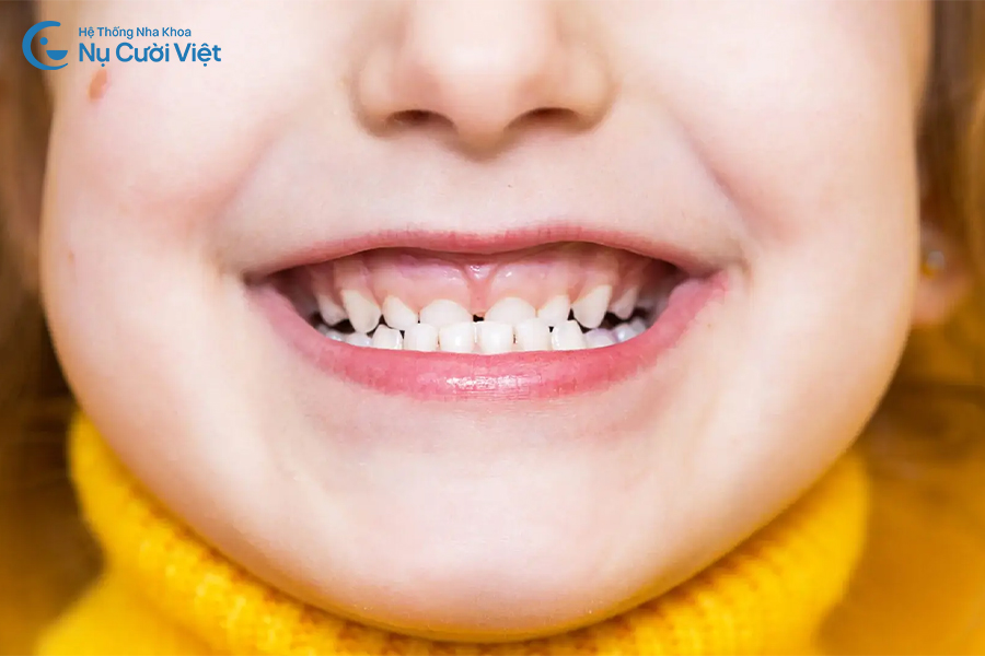 Nụ Cười Việt - MÓM Ở TRẺ: VÌ SAO BA MẸ NÊN NIỀNG RĂNG SỚM CHO CON?