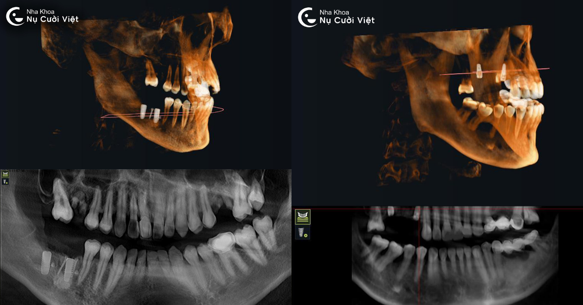 lợi ích chụp conebeam ct trước khi cấy ghép implant