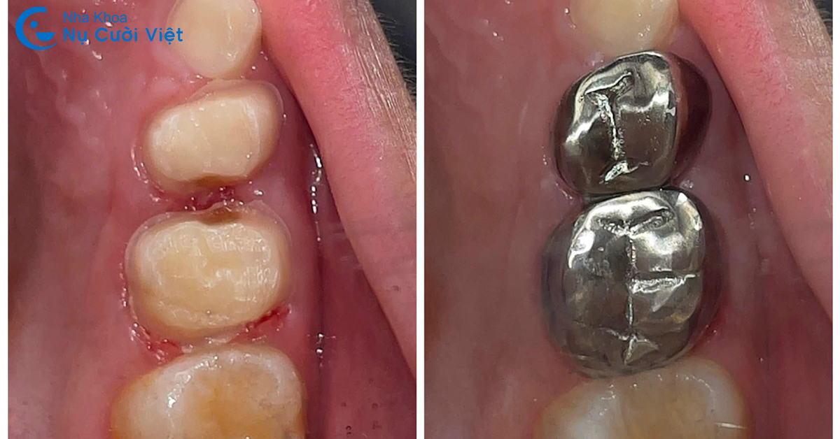 lợi ích khi chụp thép răng sữa cho trẻ