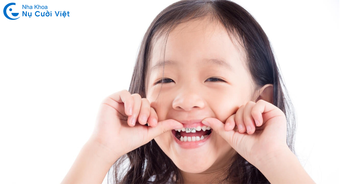 chụp thép răng sữa cho trẻ em là gì