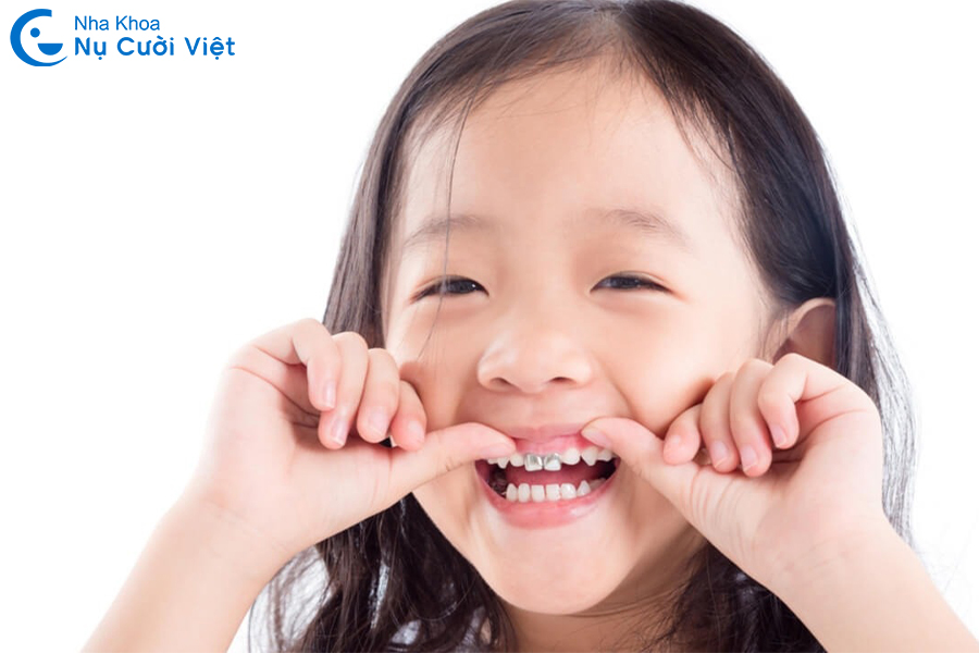 Nụ Cười Việt - VÌ SAO CẦN CHỤP THÉP RĂNG SỮA CHO TRẺ EM? TRƯỜNG HỢP NÀO CẦN THỰC HIỆN