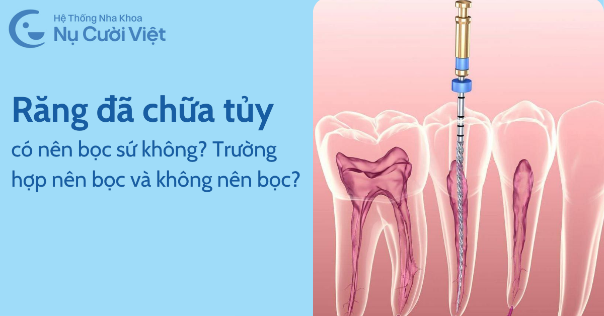 có nên bọc răng sứ cho răng đã chữa tủy không