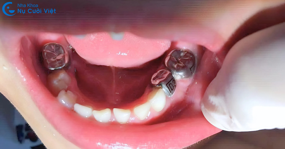 có nên chụp thép răng sữa cho trẻ không