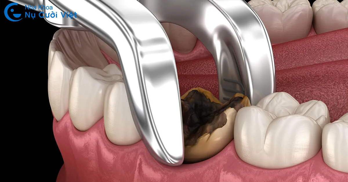 trường hợp nhổ răng sâu bị vỡ còn chân răng