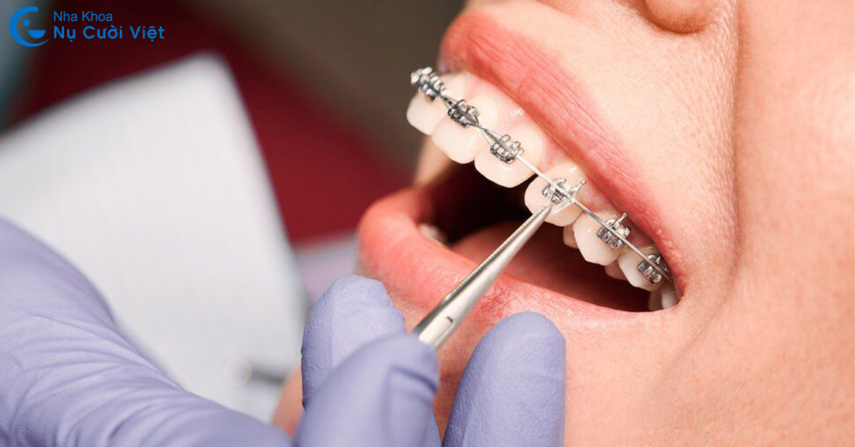 công dụng của thun niềng răng