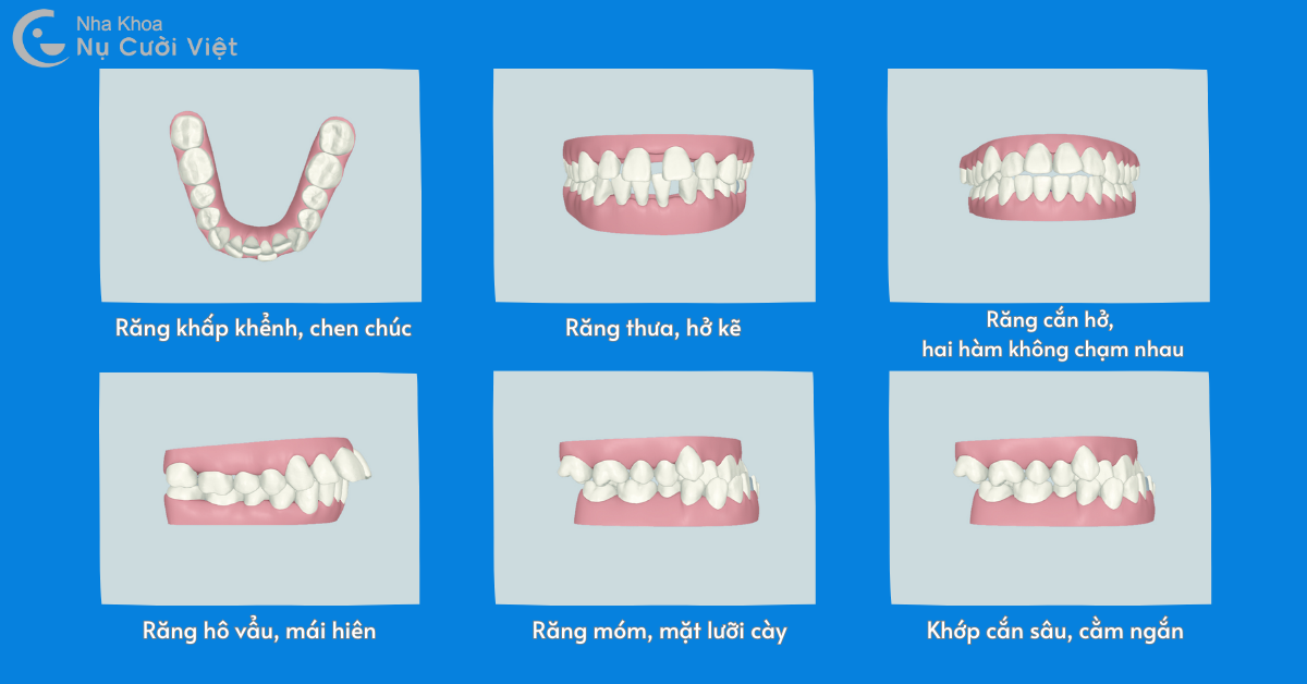 dấu hiệu nên niềng răng cho con