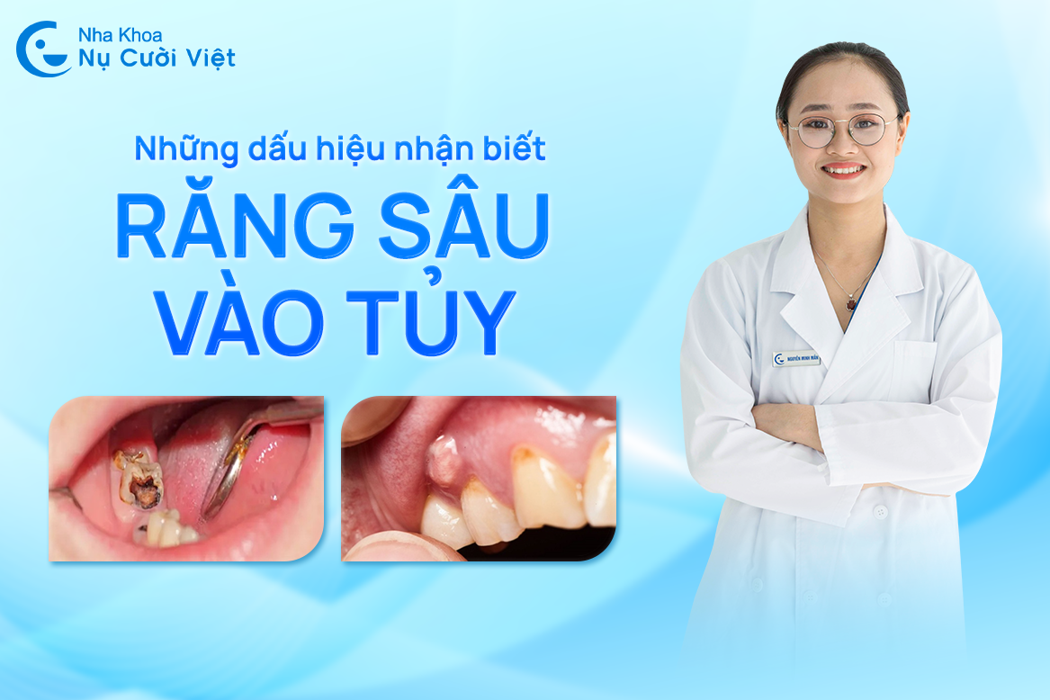 Nụ Cười Việt - TOP NHỮNG DẤU HIỆU NHẬN BIẾT RĂNG SÂU VÀO TỦY, CÁCH ĐIỀU TRỊ HIỆU QUẢ LÀ GÌ?