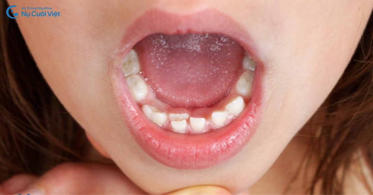 răng mọc lẫy ở trẻ em là gì