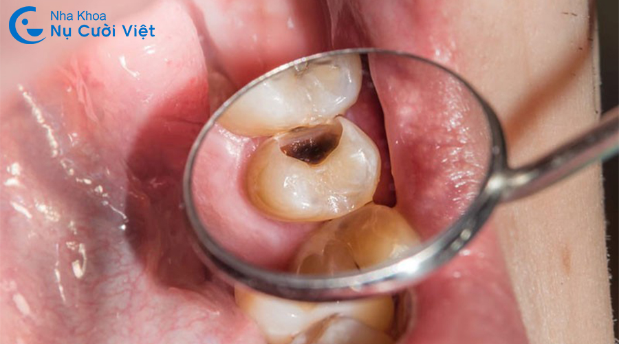 Nụ Cười Việt - Sâu kẽ răng: Nguyên nhân, dấu hiệu và cách điều trị hiệu quả
