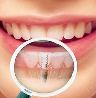 Nụ Cười Việt - Trồng răng implant