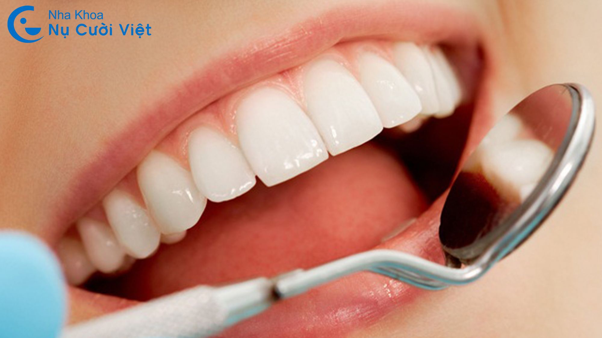 điều trị răng bị đen ở kẽ