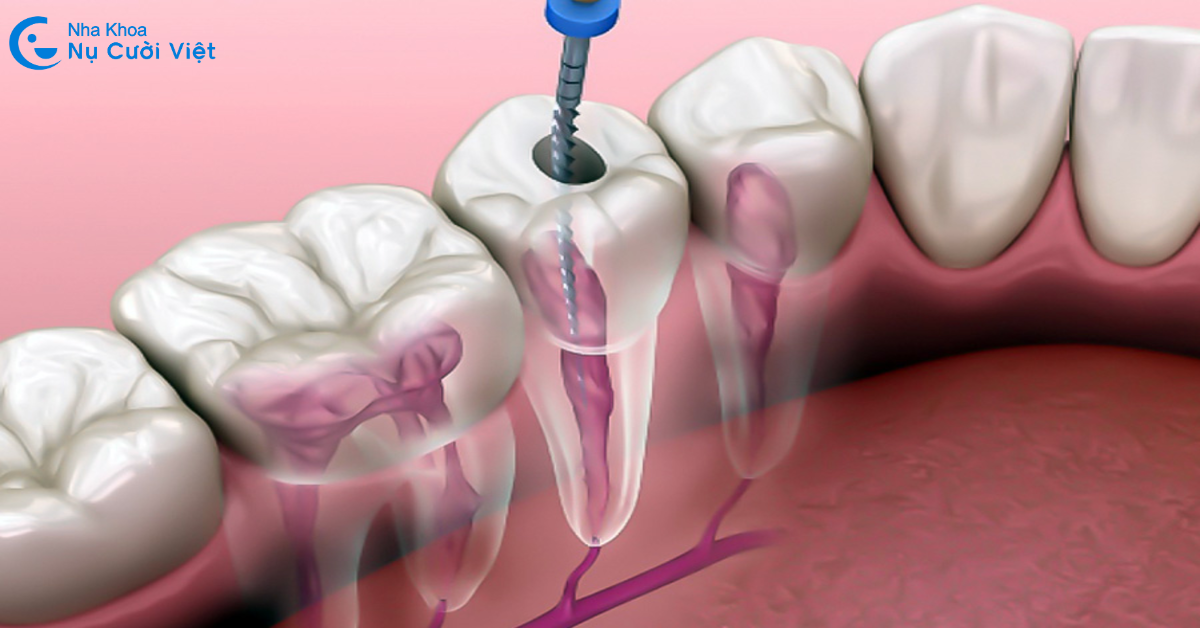 điều trị răng sâu vào tủy