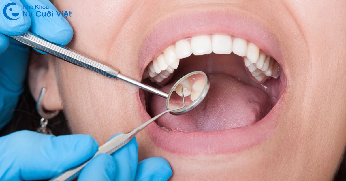cách điều trị sâu kẽ răng