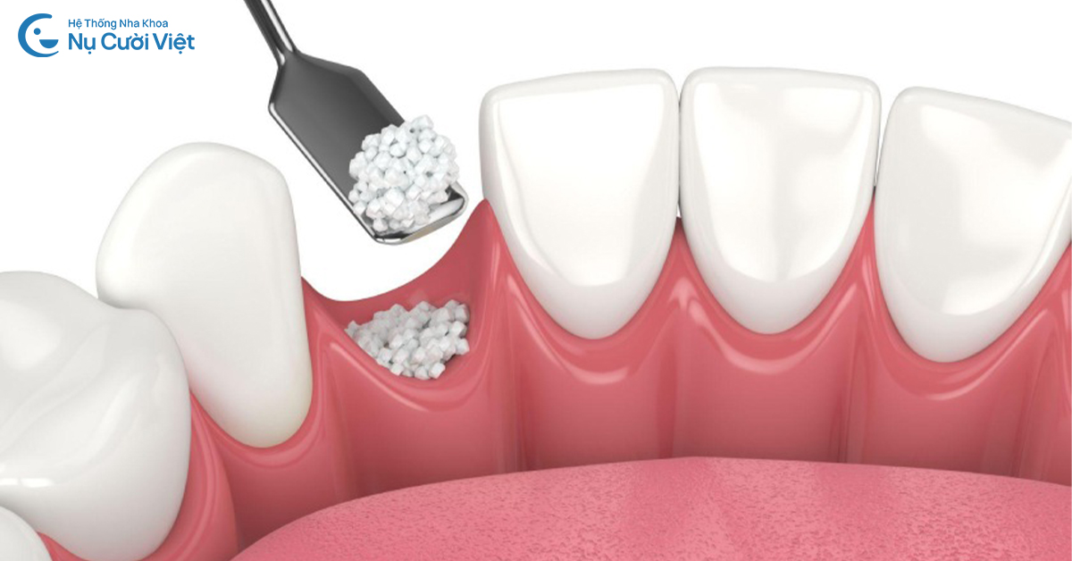 ghép xương implant khi tiêu xương hàm\