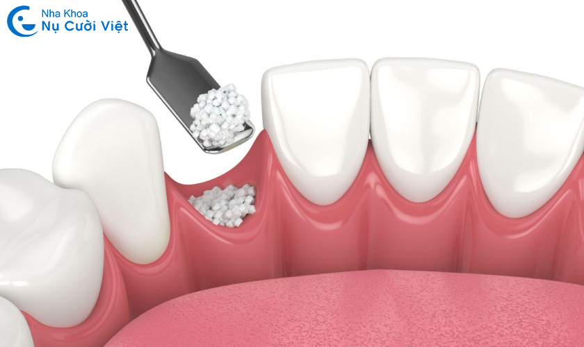 kỹ thuật ghép xương implant hiện nay