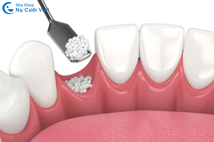 Nụ Cười Việt - Khi nào cần ghép xương trong cấy ghép Implant? Quy trình thế nào? Chi phí bao nhiêu?