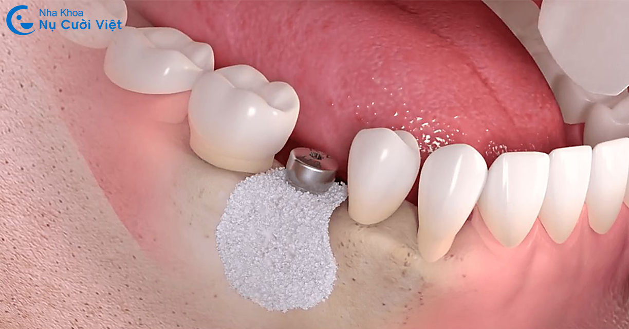 ghép xương cấy ghép implant là gì