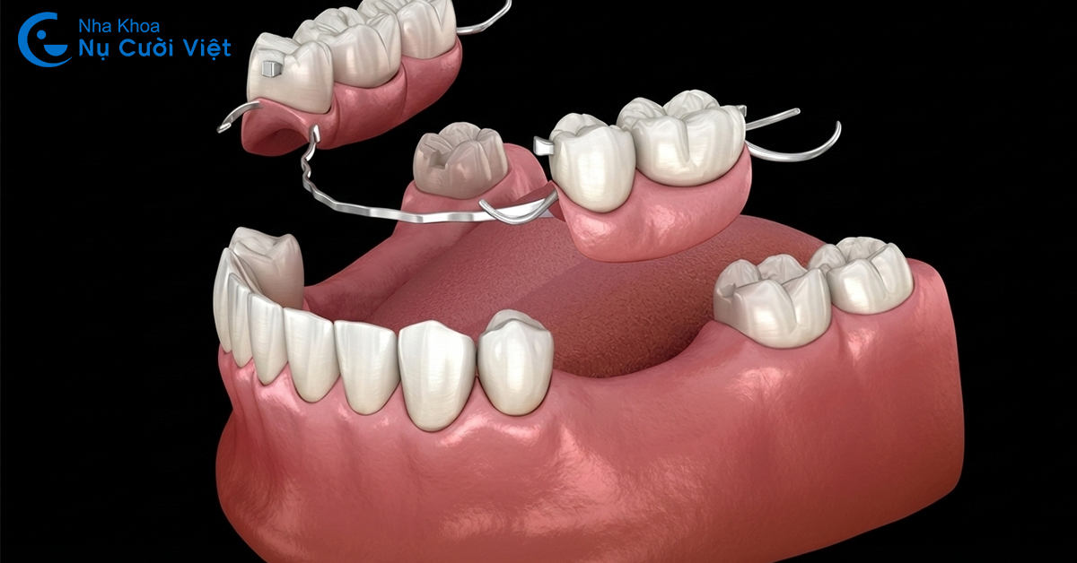 giải pháp khi mất răng